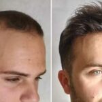 VALZOMI SISTEMAS CAPILARES