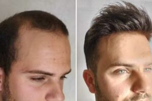 VALZOMI SISTEMAS CAPILARES